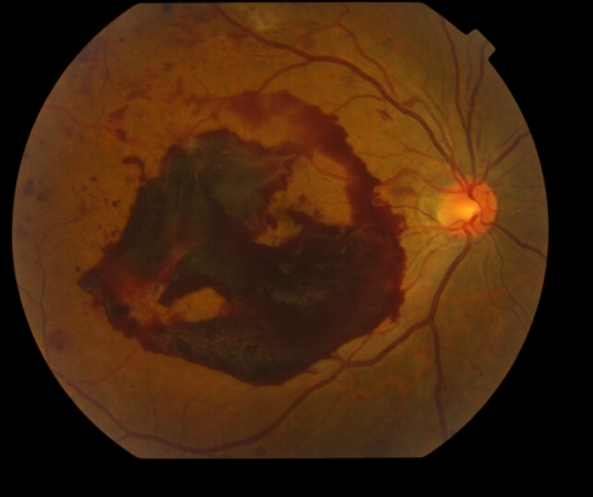 Gallery Sri Isha Retina Foundation